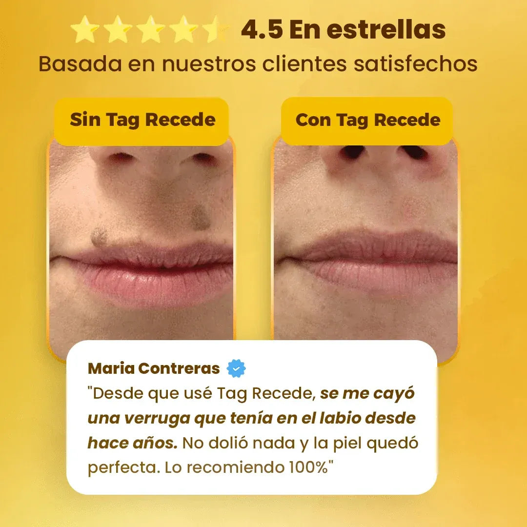 Veneno de Abeja ™  - Elimina Verrugas En 7 Días De Forma Natural y Sin Dolor